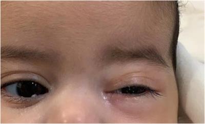 A case report of a patient with recurrent and severe infections highlighting the importance of considering inborn errors of immunity
